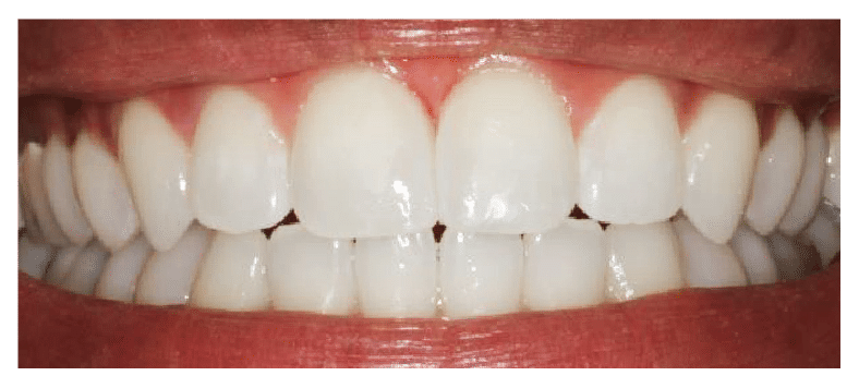 After Six Month Smiles Bristol