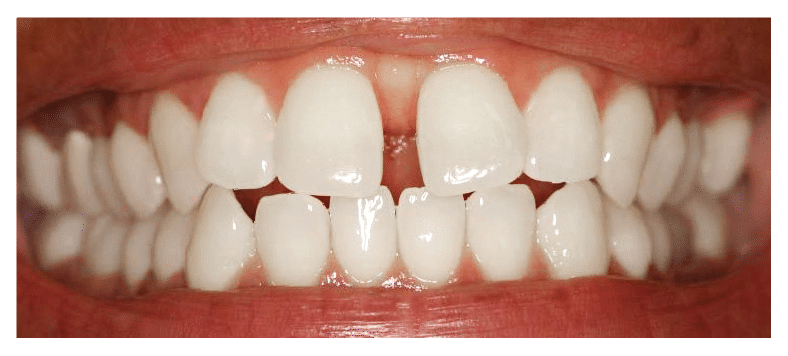 Before Six Month Smiles Bristol