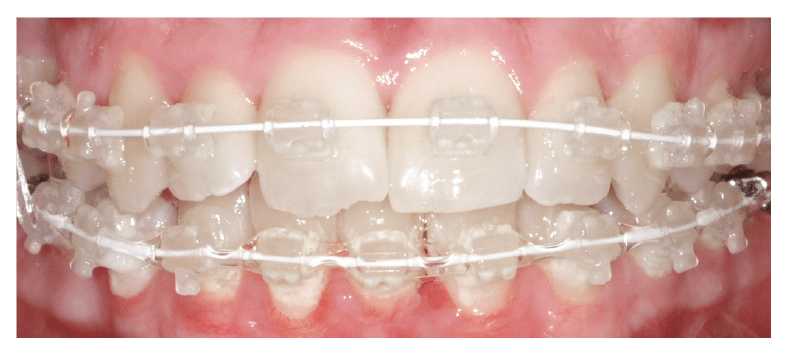 During 6 month smiles treatment Britol