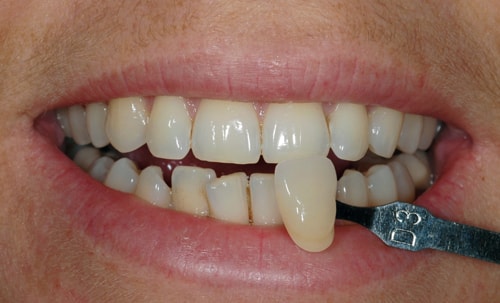 Before Teeth Whitening treatment At Dental Touch Bristol