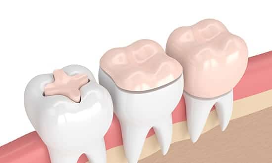 What are inlay and onlay